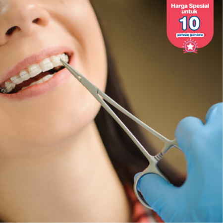 Pemasangan Behel Self Ligating Damon All Clear oleh drg. Spesialis Ortodontis di Klinik Gigi Griya Denta