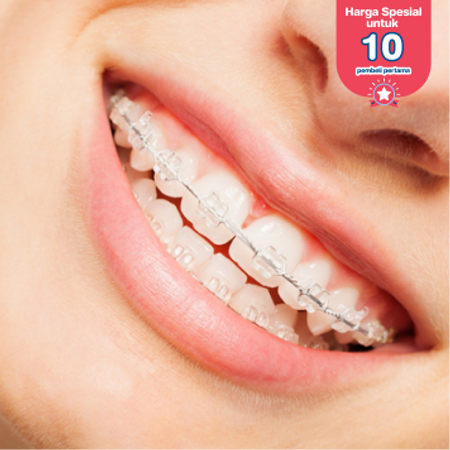 Pemasangan Behel Sapphire oleh drg. Spesialis Ortodontis di Klinik Gigi Griya Denta