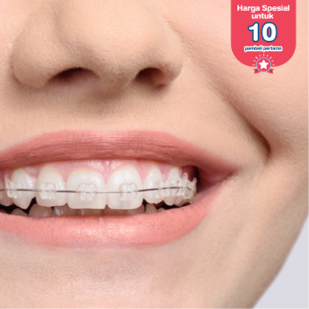 Pemasangan Behel Self Ligating Damon Semi Clear oleh drg. Spesialis Ortodontis di Klinik Gigi Griya Denta
