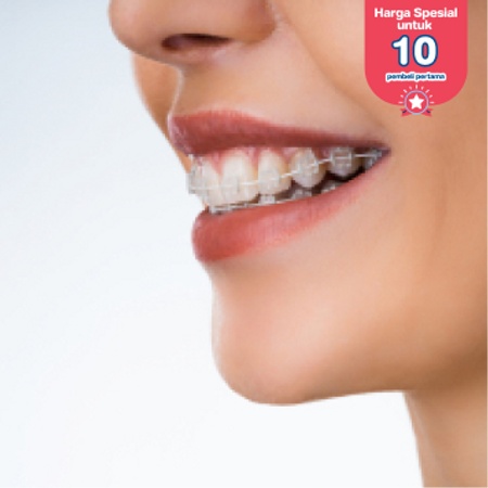 Pemasangan Behel Self Ligating Metal oleh drg. Umum di Klinik Prismadent