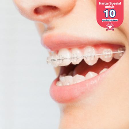 Pemasangan Behel Self Ligating (Easy Clip USA) oleh drg. Spesialis Ortodontis di Klinik Tooth Signature