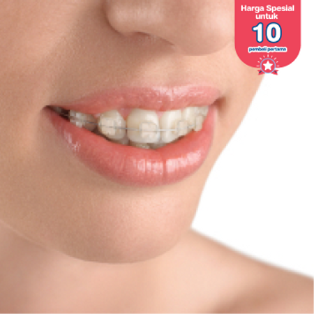 Pemasangan Behel Self-Ligating Metal oleh drg. Umum + Scaling dan Polishing + Cetak Gigi di DENTALMATE DENTALCARE