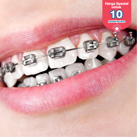 Pasang Behel Metal oleh drg. Umum di Klinik Djanti Medika