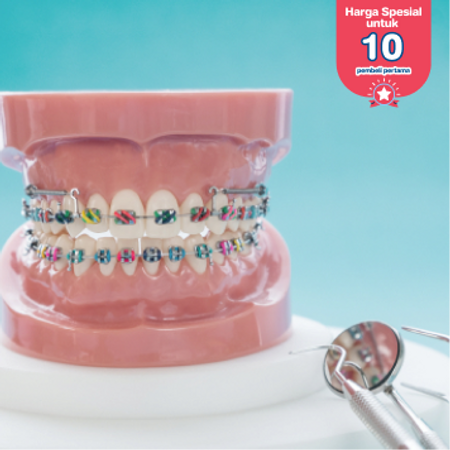 Pasang Behel Metal Mini USA di Cendrawasih Dental Clinic
