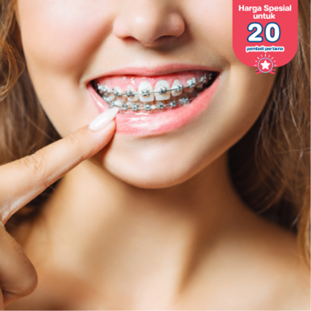 Pasang Behel Metal oleh drg. Umum + Scaling di FD Care