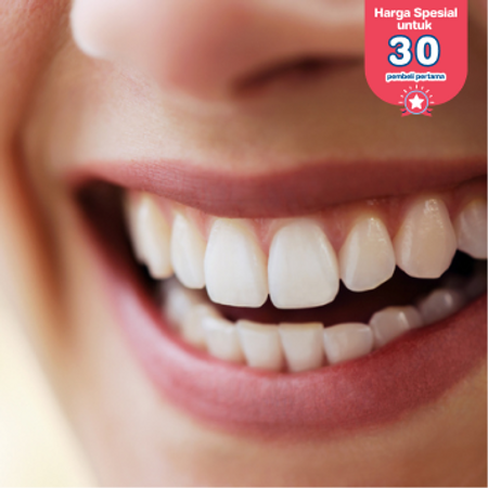 Direct Veneer Composite 1 Gigi di Fre Dental Care