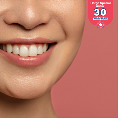Direct Veneer Composite 1 Gigi oleh drg. Spesialis Prostodonsia di Akatara Clinic
