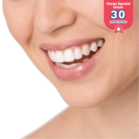 Direct Veneer Composite 1 gigi di Griya Denta Clinic