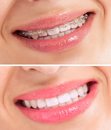 Pasang Behel Self Ligating Metal drg. Umum di AM Dental Care Cabang Cengkareng