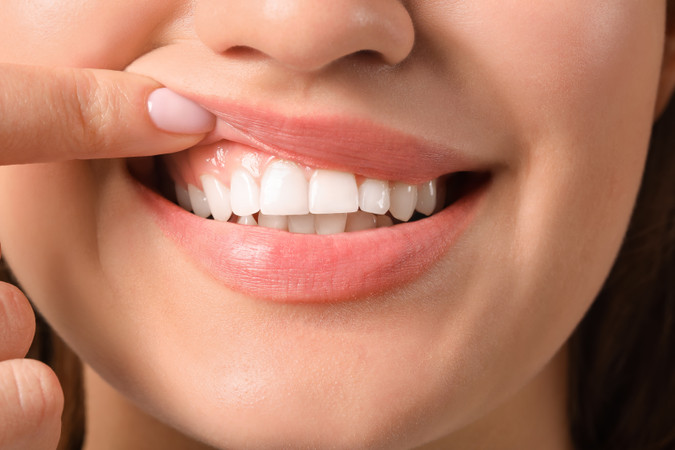 Direct Veneer Composite di Klinik Gigi drg Mia