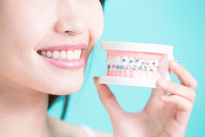 Pemasangan Behel Metal Gigi Atas & Bawah + Cetak + Scaling di RRDC Dental Care