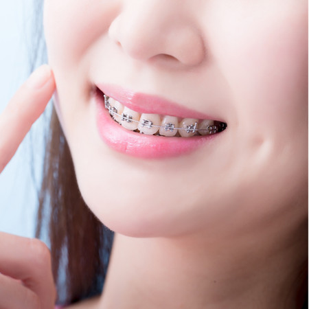 Pemasangan Behel Metal di Amalia Dental Care
