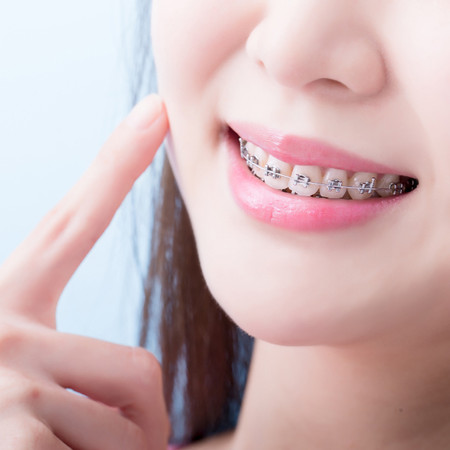 Self Ligating Metal Braces di DDC Caman
