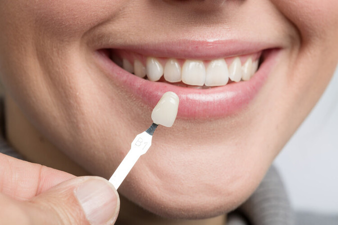Direct Veneer Composite 1 Gigi di My Dental Studio