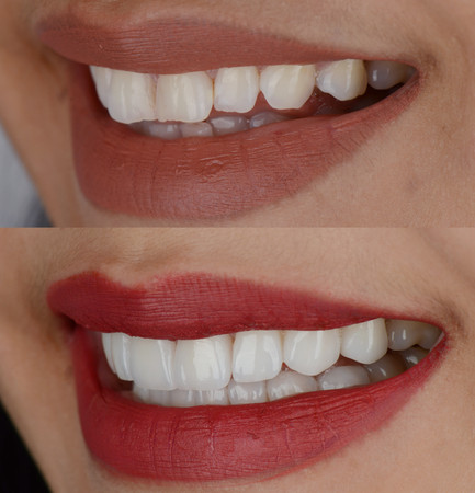 Direct Veneer Komposit 16 Gigi di Praktik drg. Putri Linda Sari