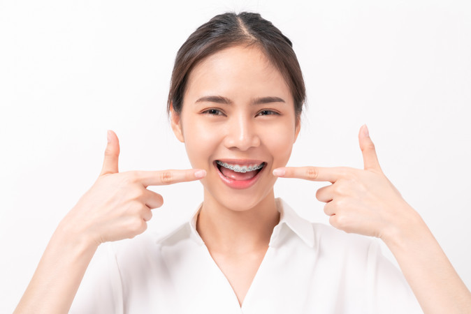 Pemasangan Behel Self Ligating oleh drg. Umum di Bioesthetic Dental Care