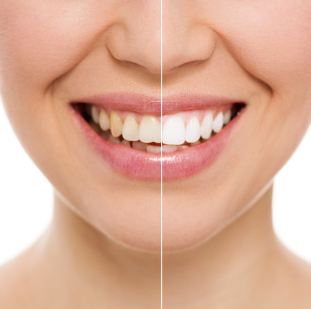 Teeth Whitening with UV Technology di Inti Dental Care