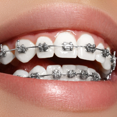 Pasang Behel Metal oleh drg. Umum di Gigiku Family Dental Care