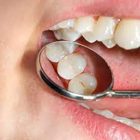 Scaling Gigi (Kasus Ringan-Sedang) di NP Dental Clinic