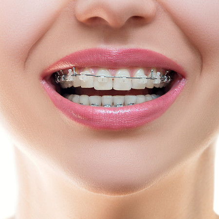 Pemasangan Behel Self Ligating Metal Damon + Rontgen Gigi di Parahita Lab di Klinik Gigi Cheer Up