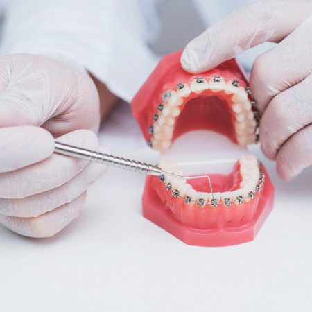 Pemasangan Behel Self Ligating oleh drg Umum di Prudentalcare
