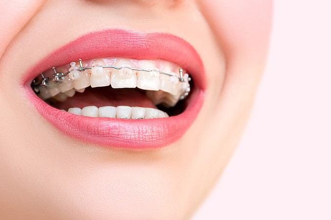 Pasang Behel Damon Clear oleh drg. Spesialis Ortodontik di JB Dental Clinic