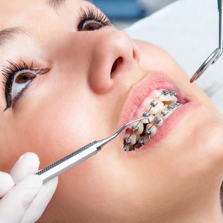 Pemasangan Behel Self Ligating Metal Damon oleh drg. Ortodonti di JB Dental Clinic