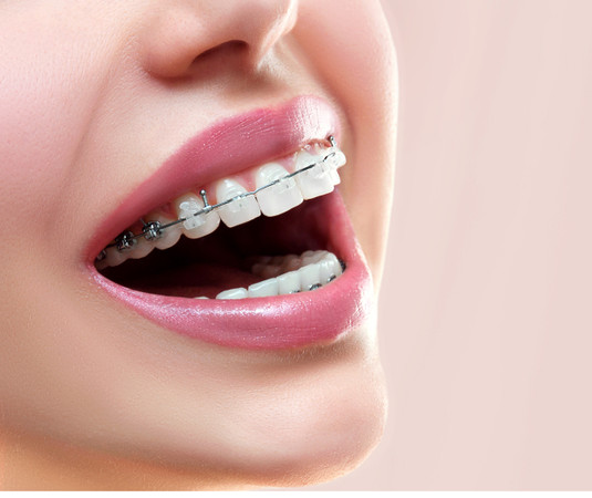 Pemasangan Behel Self Ligating oleh drg Umum di Adore Dental Clinic