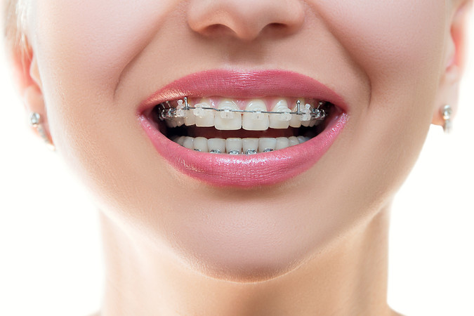 Pemasangan Behel Self Ligating Ceramic oleh drg. Umum di Mydentismile