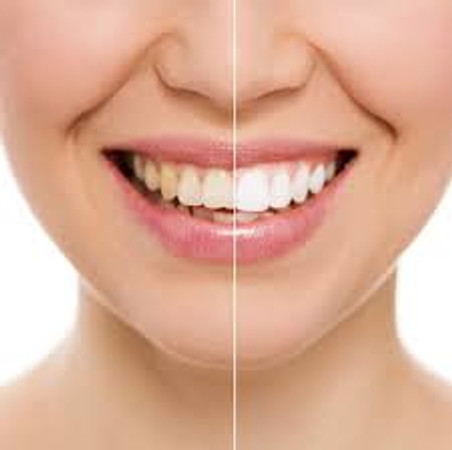 Tray Bleaching Gigi Tambahan oleh drg. Umum di Smile Up Dental Clinic