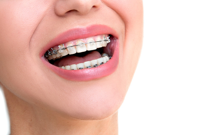 Pemasangan Behel Metal Damon oleh drg. Umum di Cling Dental Clinic