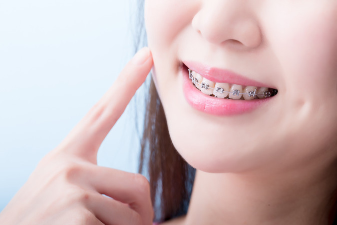 Pemasangan Behel Self Ligating Metal oleh Dokter Gigi Umum di Edental