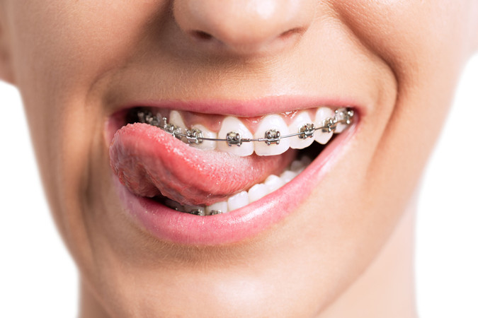 Pasang Behel Metal oleh drg. Specialis Ortodontik di Estetika Dental Clinic