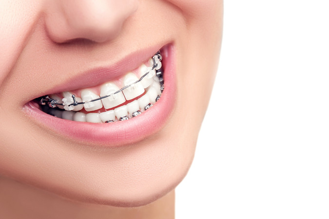 Pemasangan Behel Self Ligating drg. Spesialis Orto di Estetika Dental Clinic