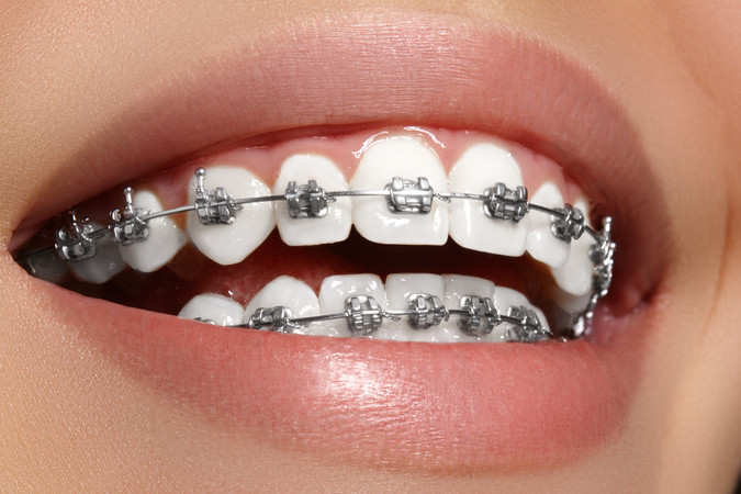 Pasang Behel Metal per Rahang oleh drg. Umum di Sanafa Dental Clinic