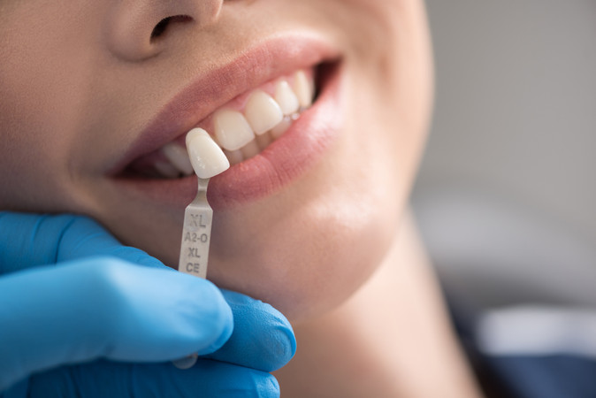Direct Veneer 6 Gigi di Canina Dental Care