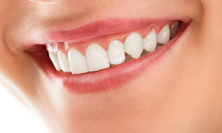 Direct Veneer Natural White di Global estetik