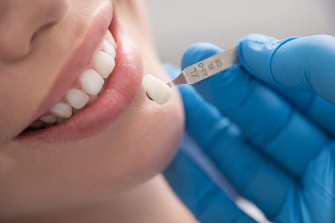 Bleaching Gigi dengan LED di Shan Dental Care