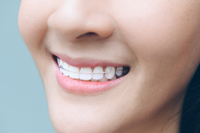 Pasang Behel Damon Metal di CS Dental