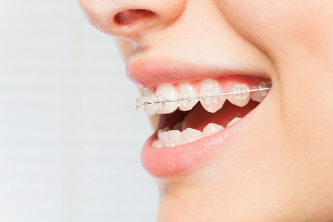 Pasang Behel Self Ligating Mico One di Akatara Clinic