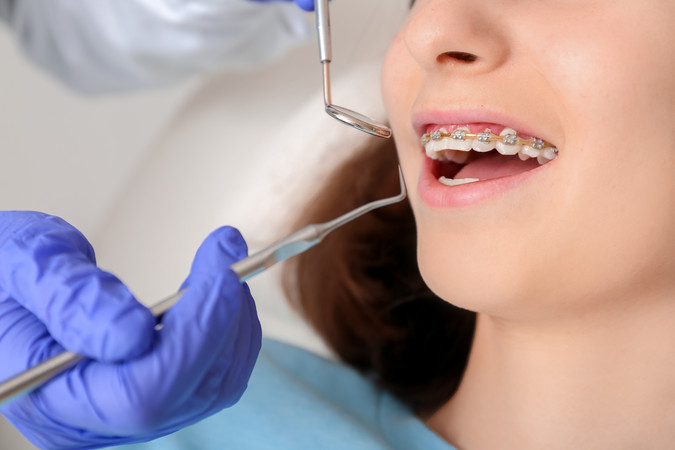Paket Promo July 2: Pasang Behel Metal Deluxe + Cetak Model Gigi + Scaling Gigi + Rontgen Gigi di Halo Dentist