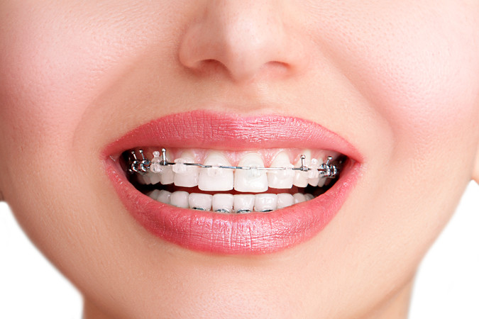 Pasang Behel Self Ligating Easy Clip oleh drg. Umum di Passion Dental Care