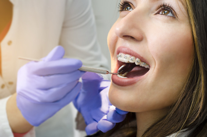 Pasang Behel Self Ligating Metal di Umma Dental