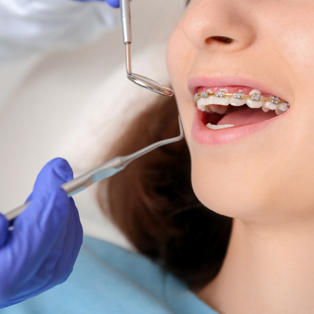 Pasang Behel Metal American Ortho di Umma Dental