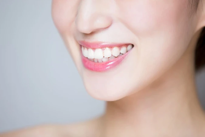 Direct Veneer Komposit 16 Gigi di Tooth's Kingdom Dental Care