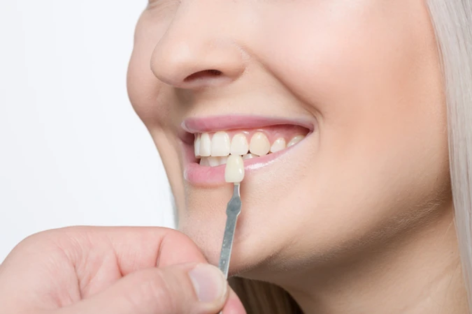 Direct Veneer Komposit dengan LED di My n Your Dentist