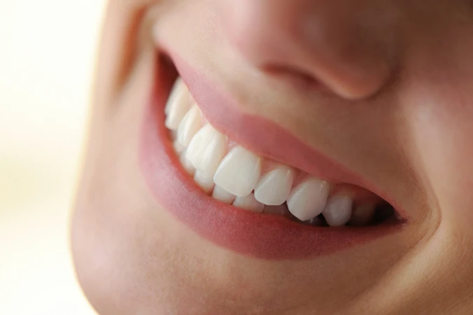 Indirect Veneer Porcelain di South Dental