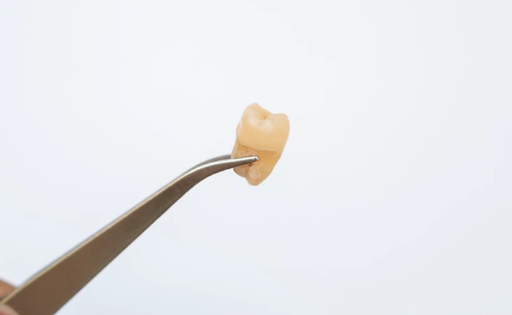 Cabut Gigi di Denta Beauty