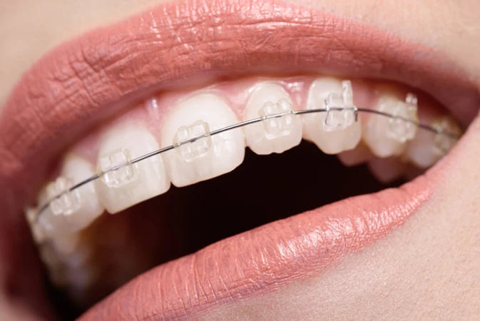 Pemasangan Behel Self Ligating Clear Damon + Pencetakan Gigi + Scaling Gigi di AM Dental Care
