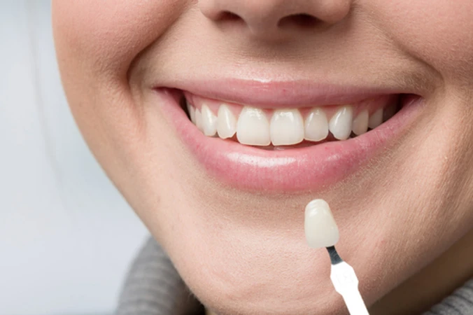 Indirect Veneer Keramik di dentist & dentists